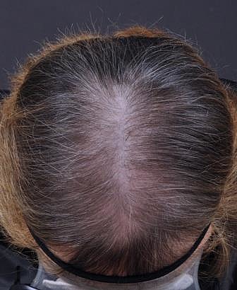 Sederma: New results on female alopecia : COSSMA