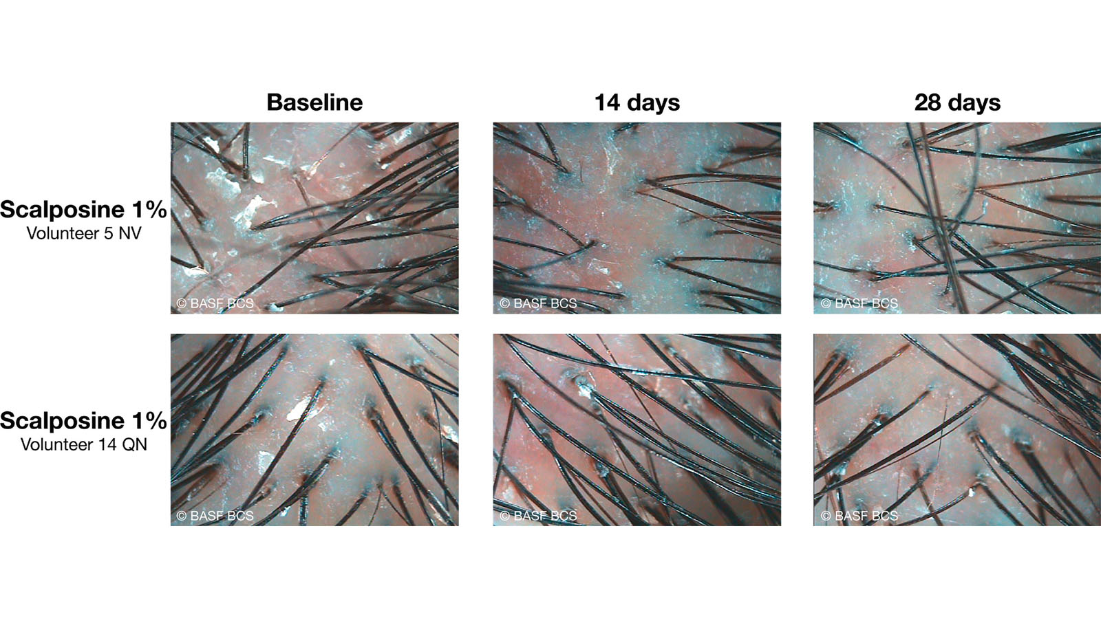 Figure 3: Illustrative pictures on the visible effect of Sarcosine at 1% towards flake removal after 14  and 28 days of application (Trichoscience Scope. BASF