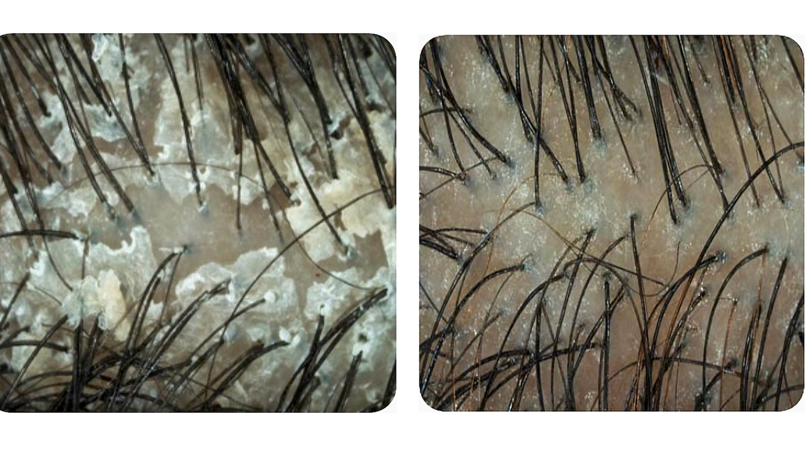 figure 2: Visualisation of improvement of scalp of one volunteer with dandruff and scalp itchiness after three weeks treatment with Apiscalp. photo: Anna Rogalska/Shutterstock.com;