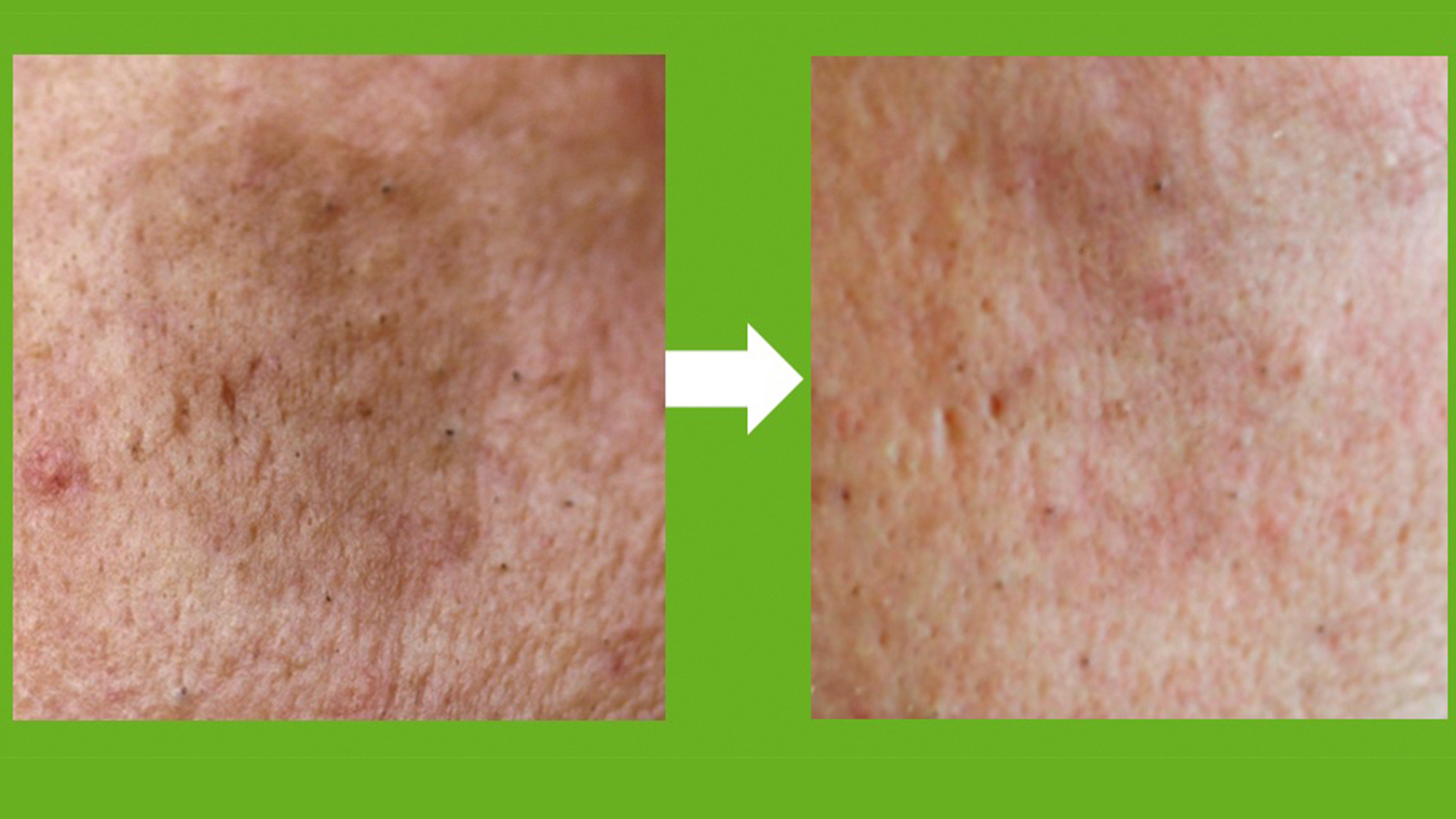 fig 3: Reduction of pigmentation after 12 weeks of daily use of a serum with 0.05% glabridin encapsulated in SmartLipids Foto: Authors