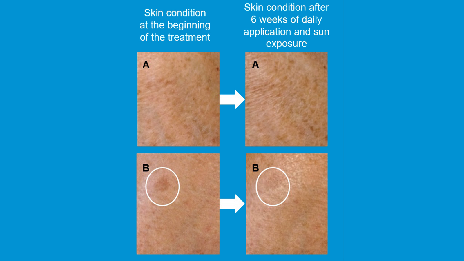 fig 4: Evidence of the improved whitening efficacy of lemongrass oil encapsulated in SmartLipids vs. “free” lemongrass oil. A: cream containing 0.23% “free” lemongrass oil; B: cream containing 0.23% lemongrass oil encapsulated in SmartLipids. A and B refer to the same test person. Figure: Authors