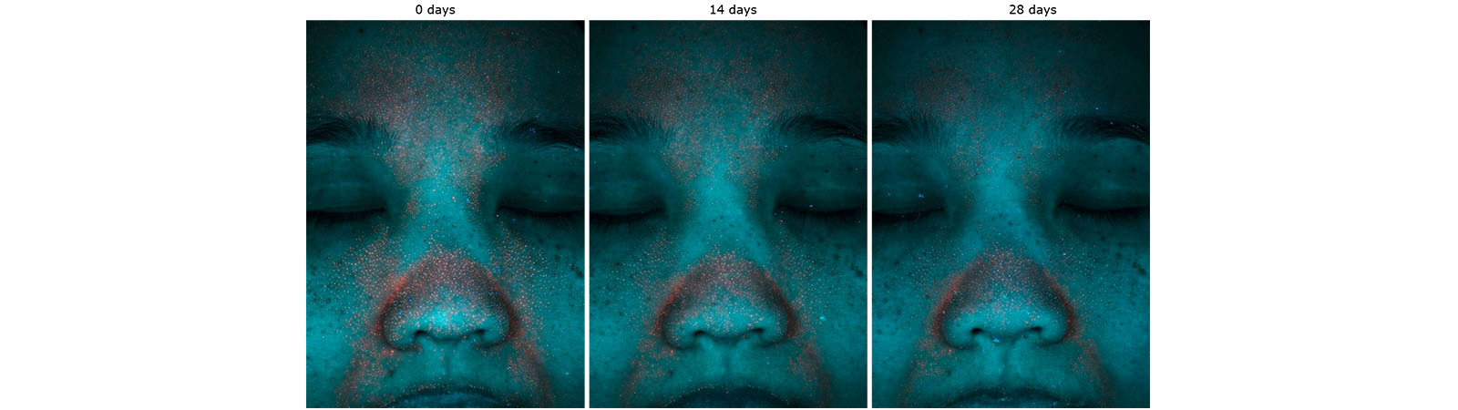 figure 1: UV photographs of a volunteer before and after 14 and 28 days of the active treatment. The presence of porphyrins can be seen as coloured fluorescent spots. Photo Lubrizol: Life Science Beauty