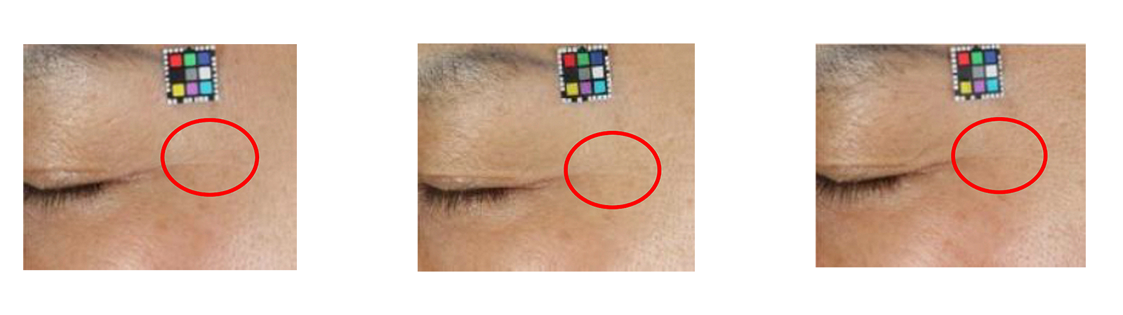Skin appearance of a study participant at the start, after four and after eight weeks. photos: IMCD