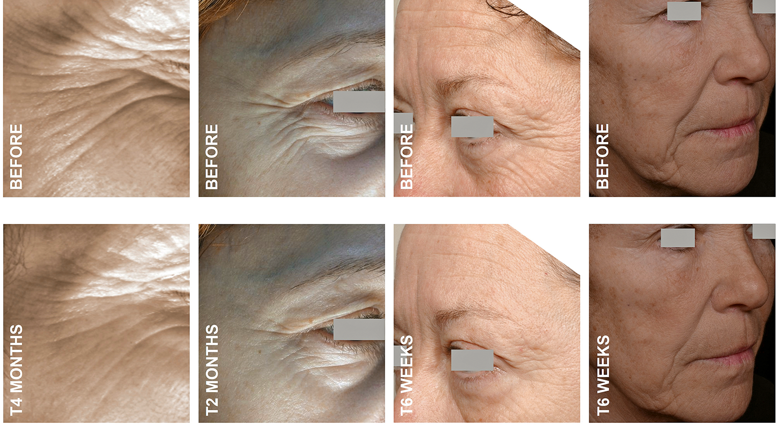 figure 1: In vivo results from the clinical studies with the different Matrixyl types. (From left: Matrixyl, Matrixyl 3000, Matrixyl Synthe’6, Matrixyl Morphomics). photos: Sederma
