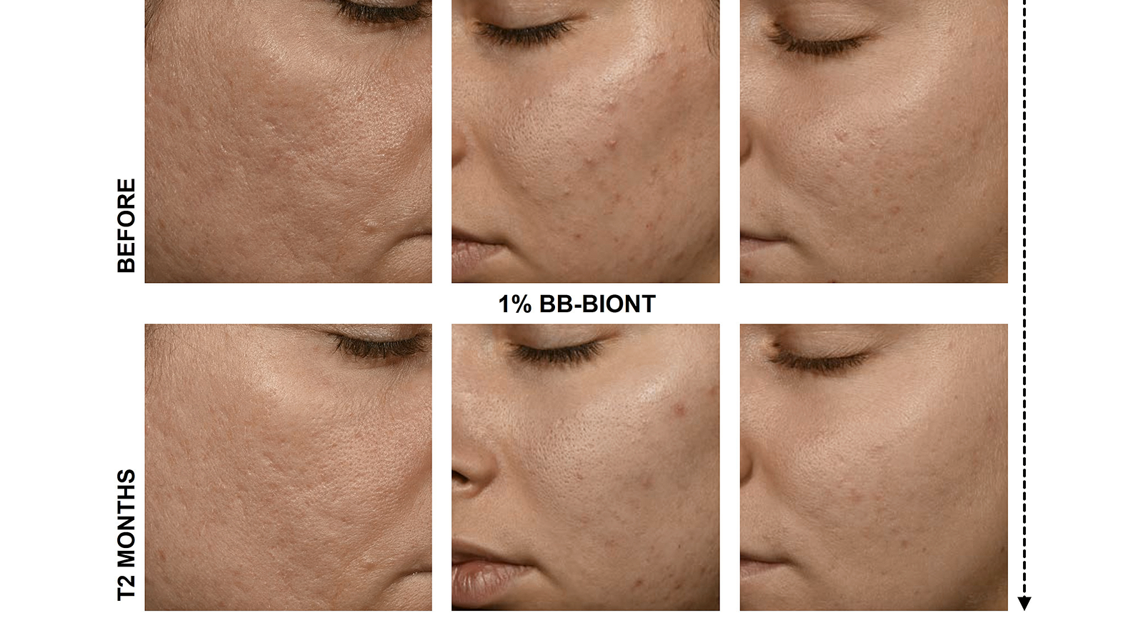 figure 2: Photographic in vivo results from the clinical studies with 1% BB-Biont. photos: Sederma