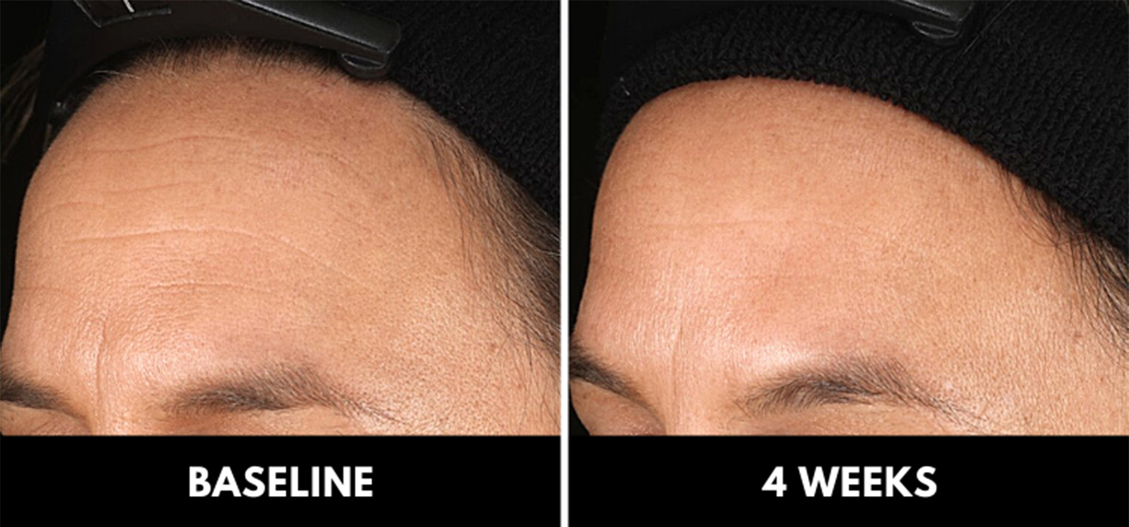 figure 3: representative image of reduction of the appearance of forehead wrinkles at (left) Baseline and 28 days treatment with CelluCap R (right).