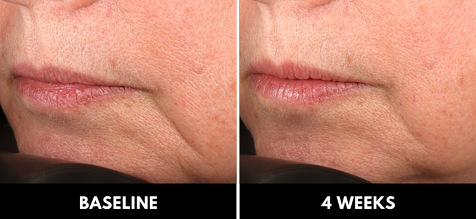 figure 4: representative image of visible softening of marionette lines at baseline (left) and 28 days treatment with CelluCap R (right).