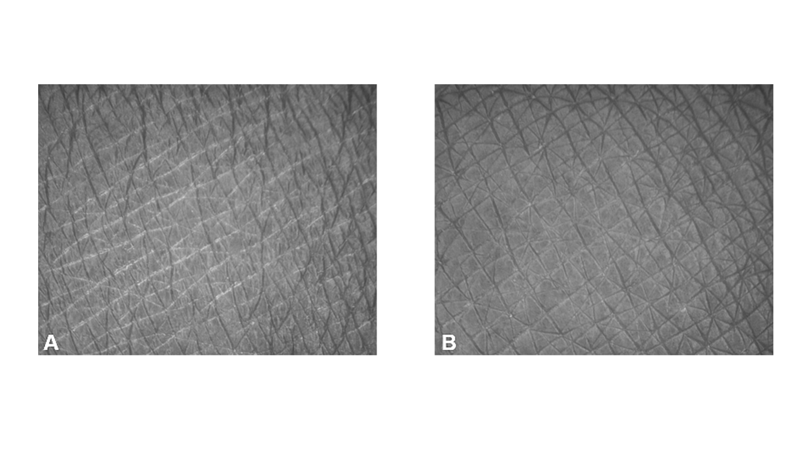 figure 2: In vivo effects on visual signs of skin dryness. A: Day 0 (Baseline); B: Day 28 after treatment with 0.5% SymReboot L19 in formulation (subject #42).