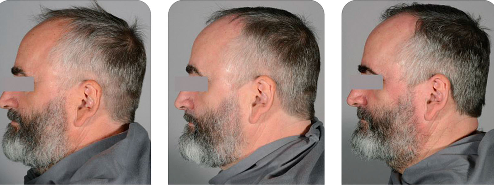 A reduction in the proportion of grey hair per square centimetre by more than three times can be seen. Example Subject #23: over 20,000 hairs have regained their natural hair colour. (Pictures from left to right: M0, M2,5, M5)