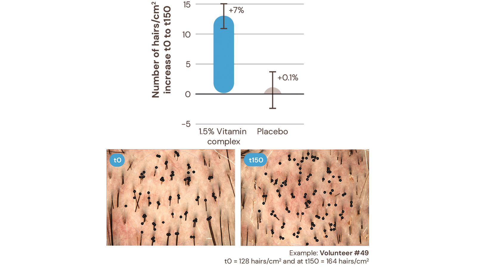 figure 1:Hair density increase after 5-months’ treatment with a leave-on formulation containing 1.5% Vitamin complex.