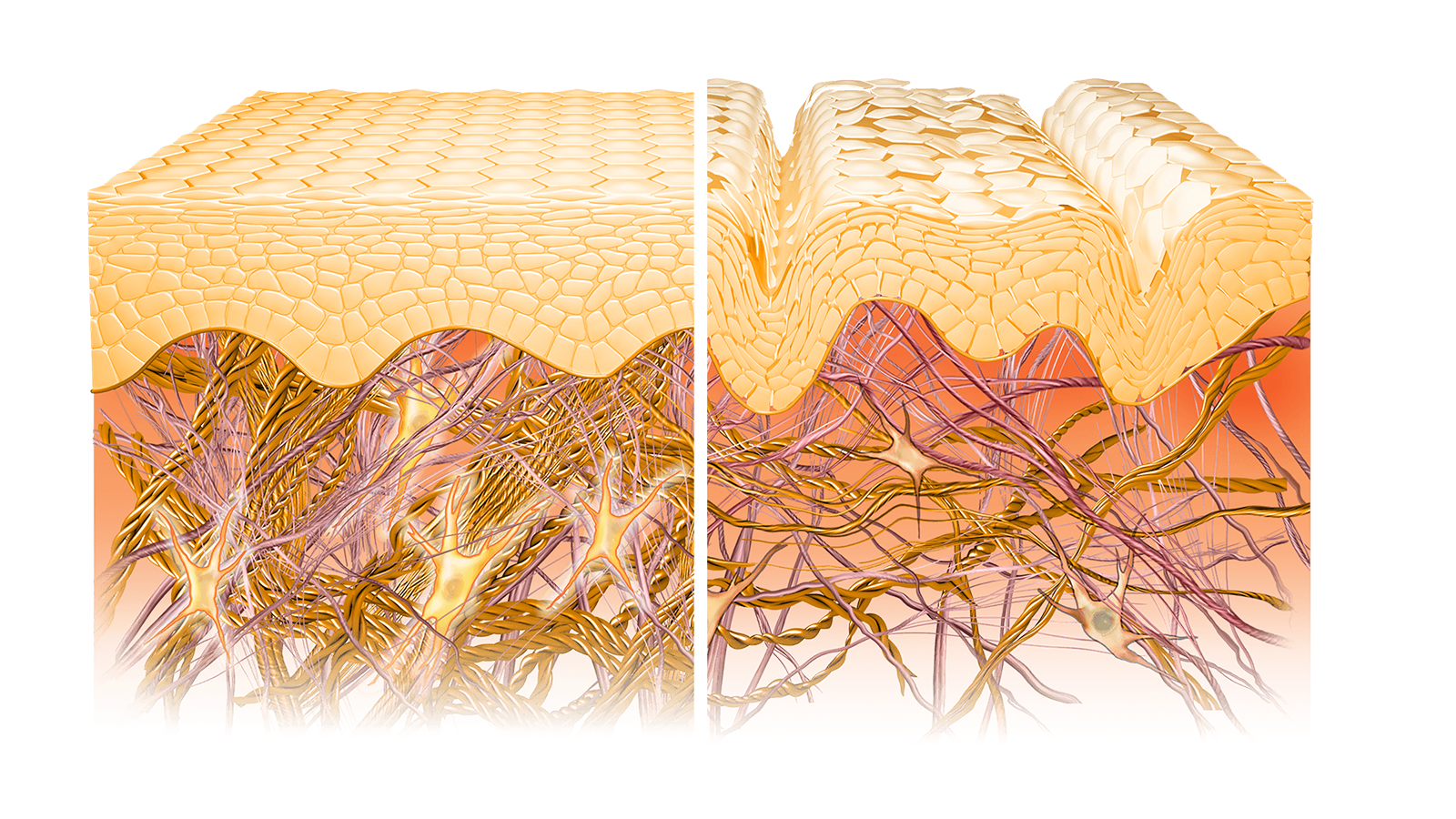 Graphic 4: Beiersdorf AG; Cross section of young skin (left) versus aged skin (right): the two skin layers, epidermis and dermis, can be seen. With the aged skin, basic cellular processes can become unbalanced in the epidermis and also in the dermis so that changes occur at tissue level, such as reduced cell and fibre density. The skin is less firm and radiant, wrinkles can form.