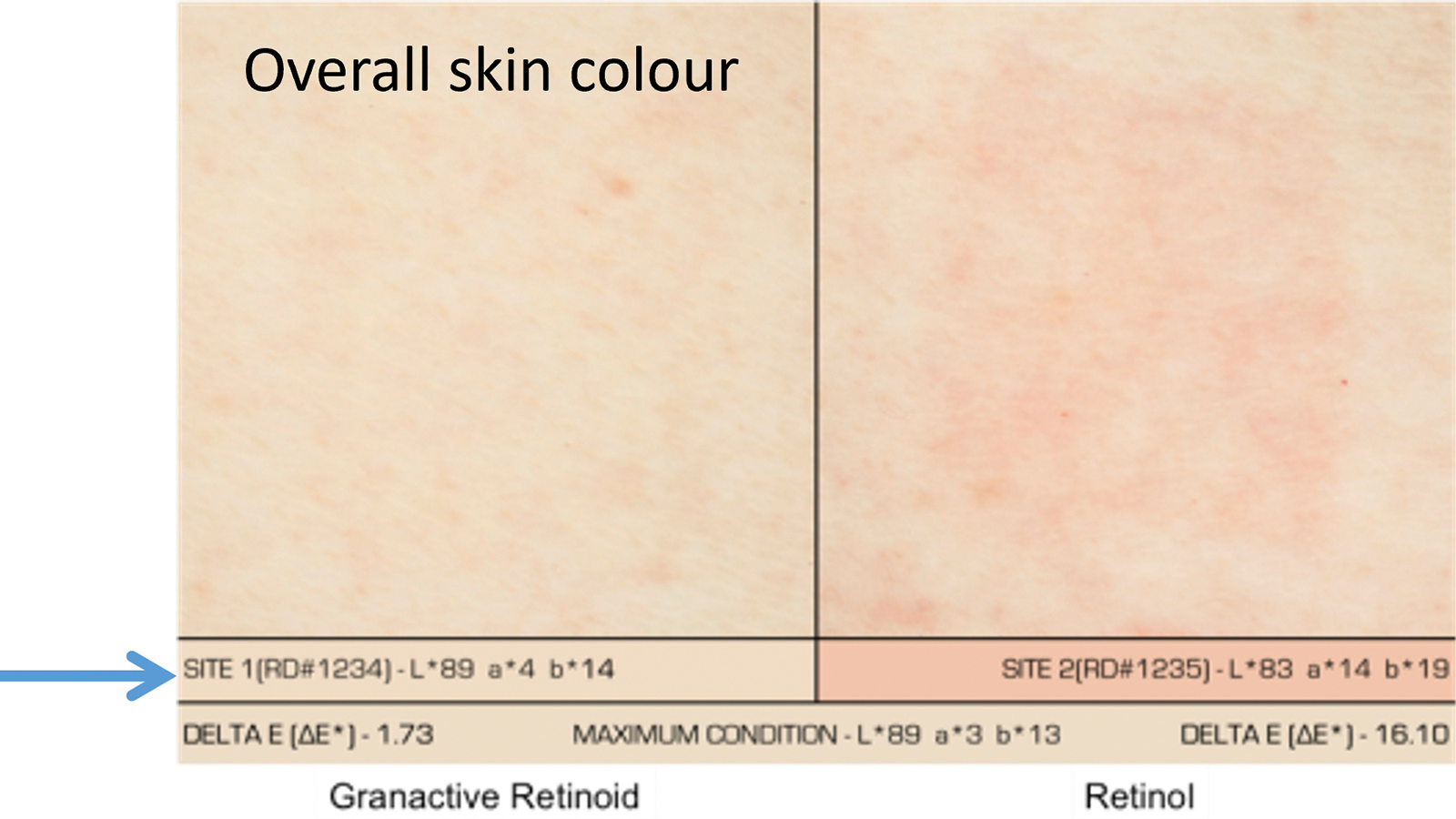 After application on a 24-hour occlusive patch test, hydroxypinacolone retinoate demonstrated a significantly lower irritation profile versus retinol. Test samples were 0.5% retinoid in Gransolve DMI. illustration: IMCD, graph: IMCD
